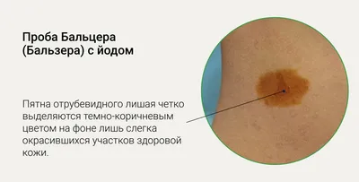 Разноцветный лишай консультация, лечение в ID-CLINIC Санкт-Петербург