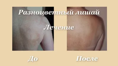 Разноцветный лишай консультация, лечение в ID-CLINIC Санкт-Петербург