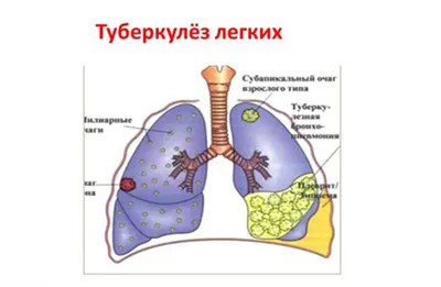 Это должен знать каждый»: туберкулез