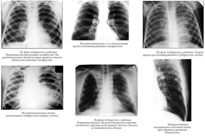 Один больной может заразить туберкулезом 10-15 человек | КГБУЗ  «Владивостокская поликлиника № 1»