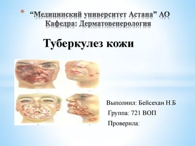 ТУБЕРКУЛЕЗ КОЖИ