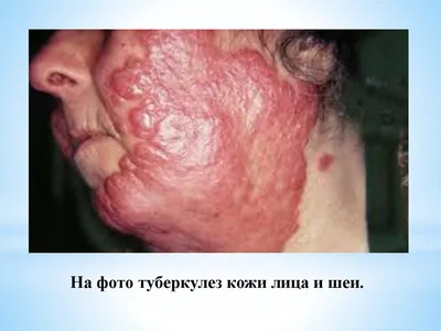 Туберкулез кожи фото