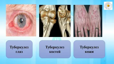 Avangard Hospital Osh - Туберкулез – заразная болезнь, которая развивается  при попадании в организм палочки Коха. Классическое течение патологии –  кашель (иногда с кровью), выраженная слабость, потеря веса, потливость,  лихорадка. Основной очаг