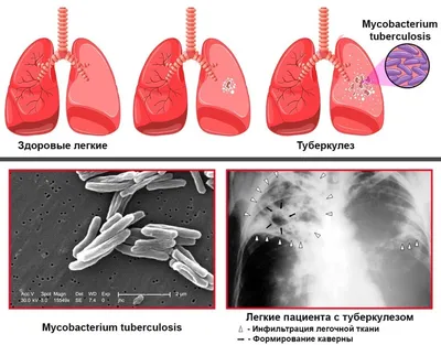 Осторожно! Туберкулез! | Казахский национальный университет им. аль-Фараби