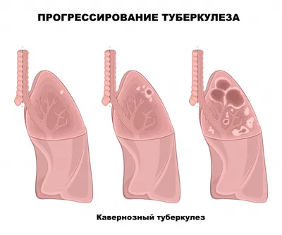 Как распознать у себя туберкулёз и отличить его от ОРВИ, рассказали медики  | Pchela.news - Новости в Челябинске