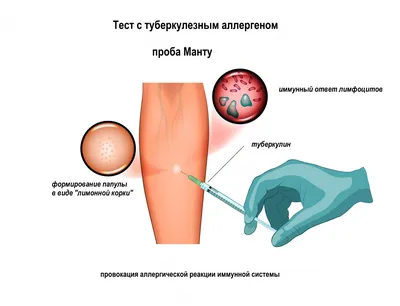 Туберкулез легких,