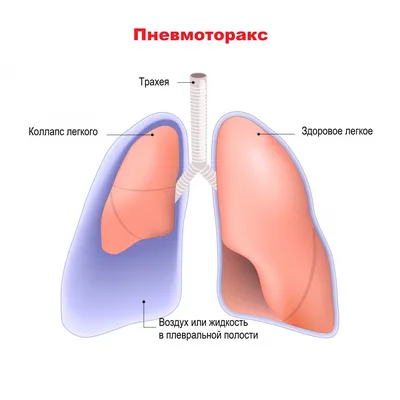 24 Марта – Всемирный день борьбы с туберкулезом | Гаврилов-Ямская ЦРБ