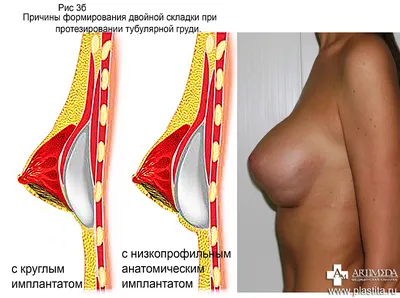 Пластика тубулярной груди - возможна ли маммопластика при тубулярности  груди?