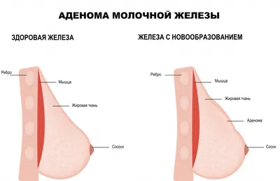 Коррекция тубулярной груди в Санкт-Петербурге – цены на операцию, отзывы