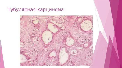 Липофилинг груди в Москве - стоимость липофилинга груди в Клинике Melanoma  Unit