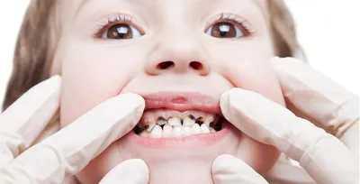 Белые пятна на зубах – откуда они берутся и как от них избавиться? - OCTA  Dental Clinic