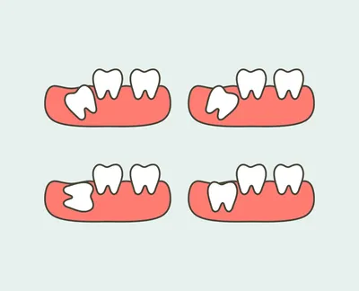 Ретинированный зуб - причины, симптомы, лечение ретинированного зуба