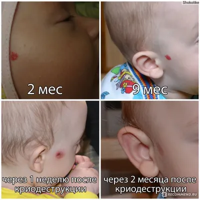 Удаление гемангиомы и винных пятен в Киеве. Цена - Coolaser Clinic