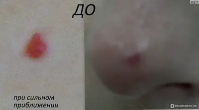 Лечение гемангиомы лазером в Кирове в клинике Возрождение