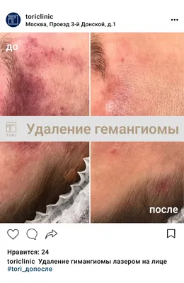 Удаление гемангиомы лазером: кожа лица, ноги в Минске в Linline