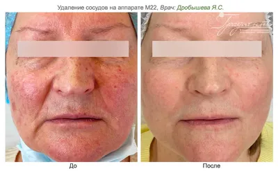 Фото до и после процедуры Удаление сосудов и лечение гемангиом в центре  лазерной медицины в Краснодаре ✨