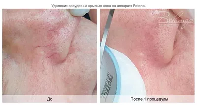 Лечение гемангиом Харьков - Центр европейской дерматологии