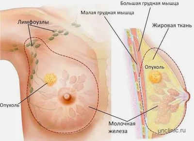 Лечение рака груди в Германии