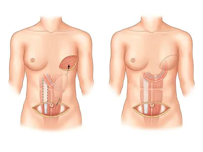 Комплекс реконструктивных операций помог пациентке восстановить форму груди,  которая была утрачена в связи с наличием ракового