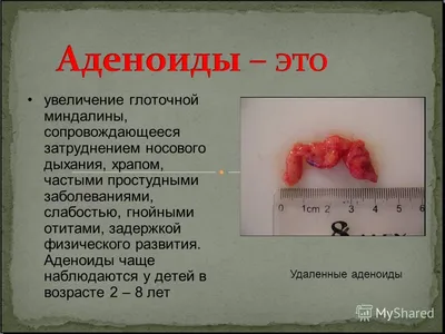 Ученые не советуют удалять детям гланды и аденоиды - АЗЕРТАДЖ