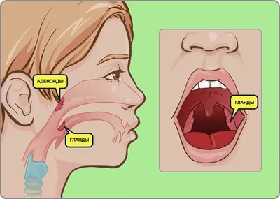 Аденотомия — безопасное и эффективное удаление аденоидов