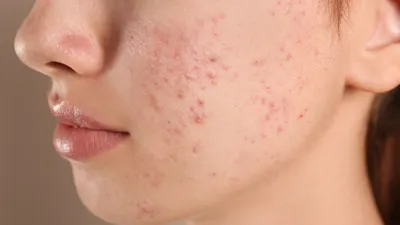 Акне: лечить или не лечить? ➤ Публикация ⭐ Косметологической Клиники  BeautyMED