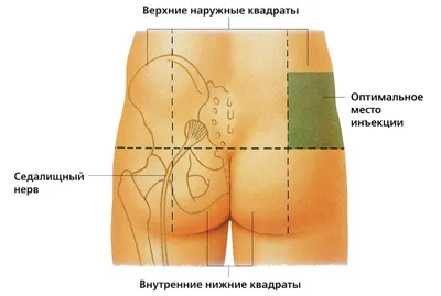 Ягодицы инъекции практика модель в стиле «хип мышцы впрыска средство  обучения | AliExpress