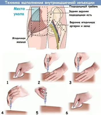 Зона укола в ягодицу рисунок - 72 фото