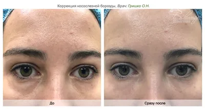 Контурная пластика: процедура, виды, преимущества | Telos Beauty