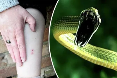 Подборка последствий после укусов разных ядовитых змей | Пикабу