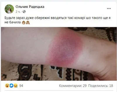 Опухла рука или нога после укуса мошки — что делать?