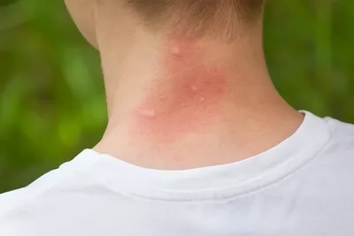 Что делать, если у вас аллергия на укусы комаров и мошек - Лайфхакер