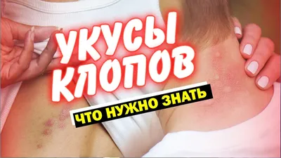 Укус клопа: как выглядит на теле человека, фото, симптомы, лечение: Уход за  собой: Забота о себе: Lenta.ru