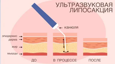 Гидраденит под мышкой и других локализаций. Причины, признаки, лечение —  клиника «Добробут»