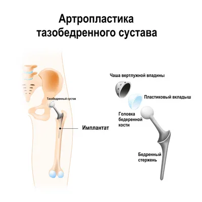 Липосакция Vaser - цена в Казани