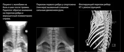 Лучевая диагностика травмы грудной клетки