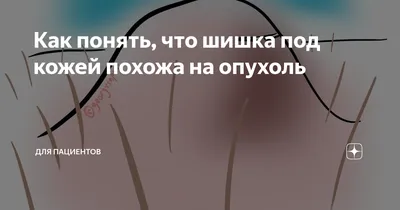 Как понять, что шишка под кожей похожа на опухоль | Для пациентов | Дзен