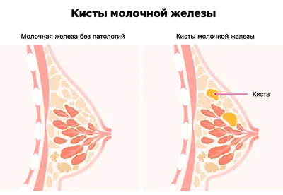 Мастопатия и беременность: что делать, симптомы и лечение | Маммологический  Центр