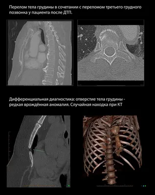 Лучевая диагностика травмы грудной клетки