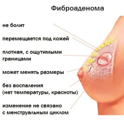 Уплотнение в молочной железе