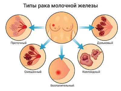 Рак молочной железы - причины появления, симптомы заболевания, диагностика  и способы лечения