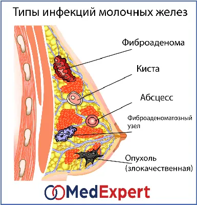 ОПУХОЛЬ МОЛОЧНОЙ ЖЕЛЕЗЫ | MED Expert