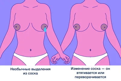 Лечение рака молочной железы на 1, 2, 3 и 4 стадиях развития болезни