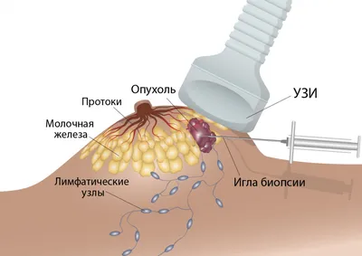 Расшифровка маммографии, Bi-RADS, пересмотр маммографии, описать маммографию