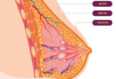 Аденоз молочных желез – симптомы предракового состояния молочной железы |  Клиники «Евроонко»