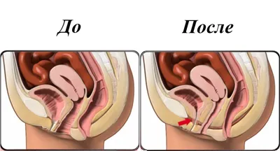 Упражнения кегеля фото до и после