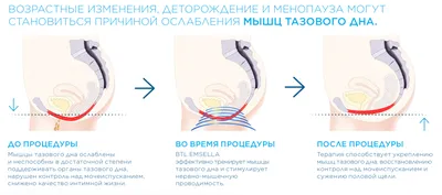 Опущение матки: причины, симптомы и лечение