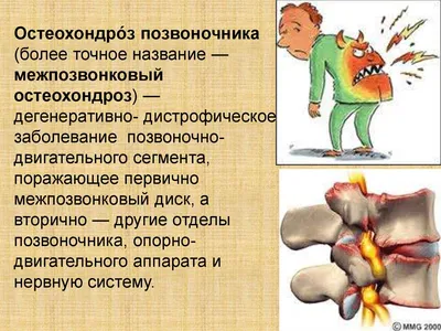 Упражнения при остеохондрозе, которые помогут снять боль и вернуть  подвижность - Лайфхакер