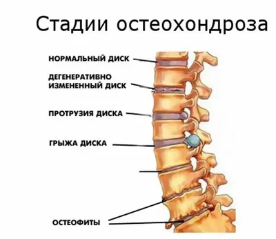 Остеохондроз и его деловые партнеры. История болезни / Хабр