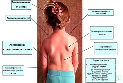 🚶 Методика дифференцированного массажа при сколиозе. Дифференцированный  массаж при сколиозе. 18+ - YouTube